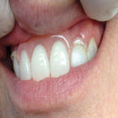 CLASP ITSOCLEAR MOLAR CLASP 2.2mm 1pcs